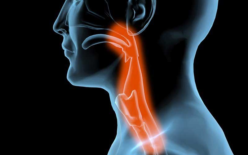 Illustration of a person with an inflamed esophagus.
